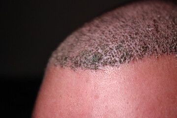 detail of the scalp after a hair transplant on black background with copy space