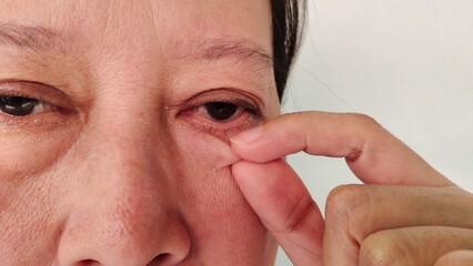 Fototapeta premium portrait the fingers holding the flabbiness adipose sagging skin under the eyes, swelling and ptosis, dark spots and blemish on the face, health care and beauty concept.