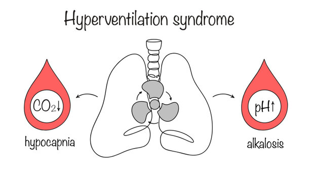 Hyperventilation syndrome
