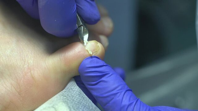Medical pedicure procedure with nail clipper tool