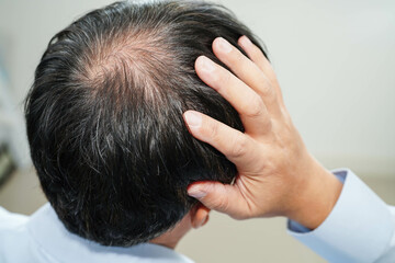 Fototapeta premium Bald head in man, hair loss treatment health problem.