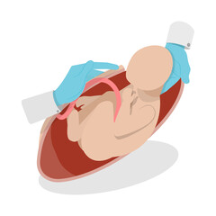 3D Isometric Flat  Illustration of Cesarean Section, Medical Surgery and Abdominal Incision
