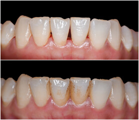 teeth deep cleaning