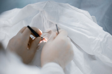 Lasik treatment, laser vision correction. Doctor performs operation replacement of lens in eye and...