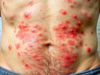 Fototapeta premium Rash on lower belly with red spots indicating possible skin irritation or allergic reaction symptoms