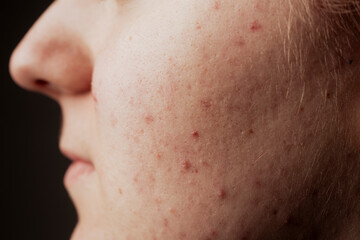 Bad skin texture Closeup acne pimple. Treatment for skin. Problem skincare. Pimples, acne, pores,...