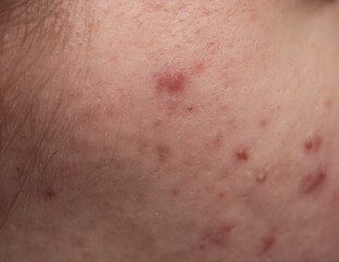 Fototapeta premium Many pimples. Bad skin. Hormonal acne, puberty. Skin acne background. Closeup acne pimple. Treatment for acne skin. Problem skincare. Pimples, pores, scars. Skincare treatment.