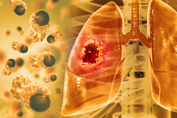 Medical Illustration showing lung cancer or bronchial carcinoma. 3d illustration