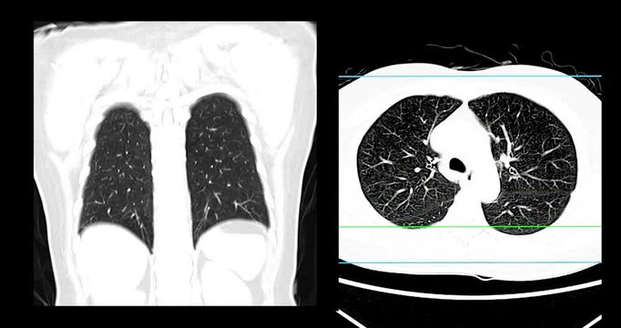 The CT scan footage shows clear and well-defined lung tissues, indicating a normal case with no signs of abnormalities.