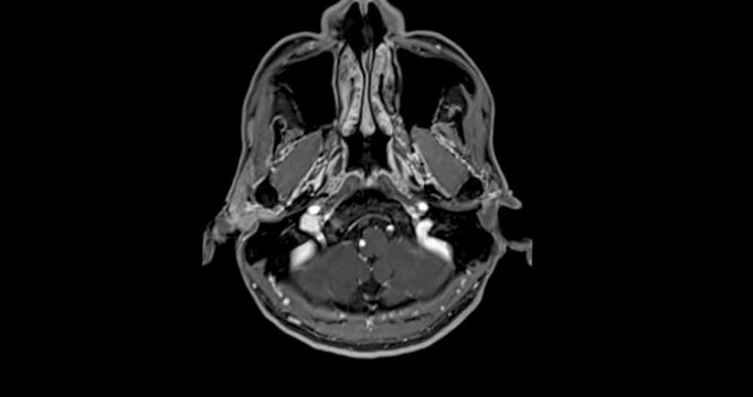 The MRI brain footage reveals areas of reduced blood flow, indicating early signs of stroke disease.