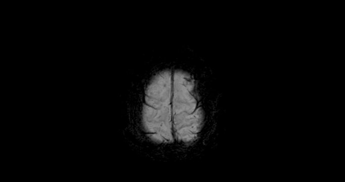 The MRI brain footage reveals areas of reduced blood flow, indicating early signs of stroke disease.