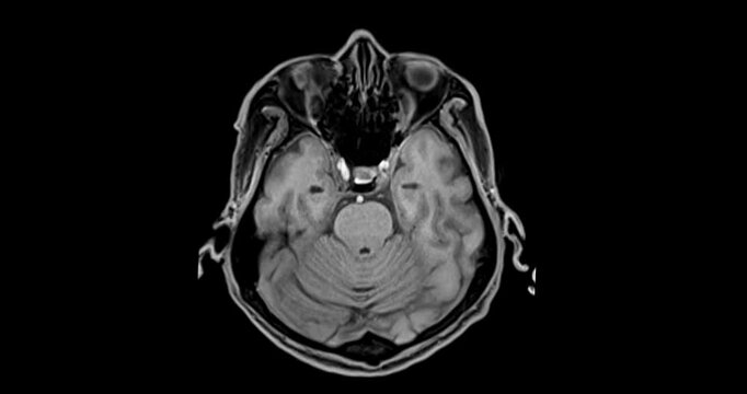 The MRI brain footage reveals areas of reduced blood flow, indicating early signs of stroke disease.