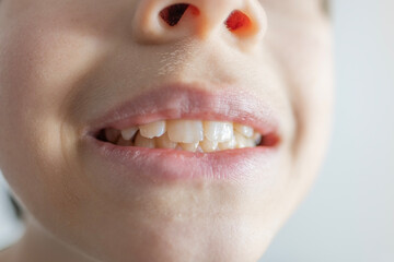 child 12 years old with malocclusion shows tooth sways and hurts, pediatric dentistry, dental...