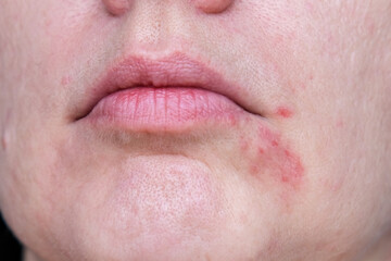 Fototapeta premium Eczema near the mouth on a woman's face close up, an adult with atopic dermatitis skin