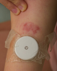allergic reaction from blood glucose monitoring sensor patch on 9 year old child's arm