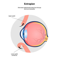 Ectropion eye ophthalmology problem infographic 