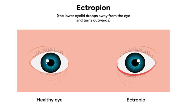 Ectropion and healthy eye ophthalmology problem 