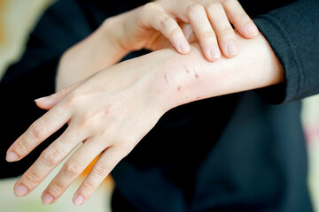 person examines their arm with visible scratches and scars, possibly indicating skin irritation or injury. focus is on hand and forearm, highlighting skin condition