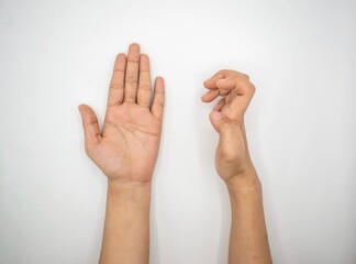 Volkmann contracture in right hand of Asian young woman.