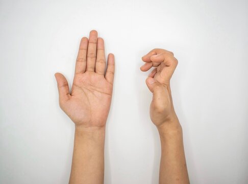 Volkmann contracture in right hand of Asian young woman.