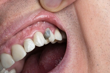 Caucasian male open mouth and teeth with broken upper premolar tooth after dental root canal...