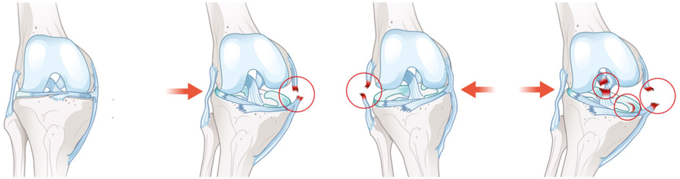 The knee's unhappy triad. Tears of the ACL, MCL, and medial meniscus. Sports injury. Medically illustration