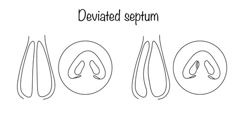 Deviated septum