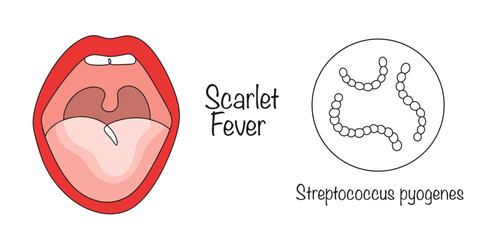 Scarlet Fever