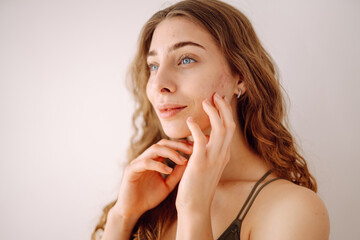 Fototapeta premium Young woman with acne and rashes on her face. Dermatology, cosmetology, skin care. Natural skin.