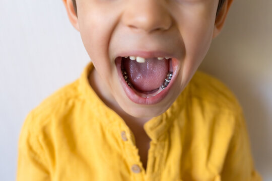 Dental care concept. Stainless steel crown a silver cap used for restoring children's teeth