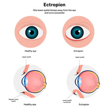 Ectropion and healthy eye ophthalmology problem