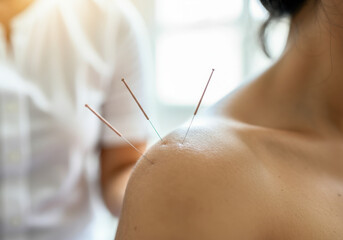 Patient is receiving acupuncture treatment on their shoulder, with needles strategically placed to alleviate pain