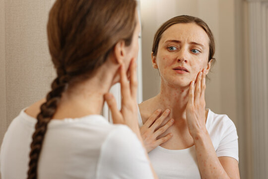 The girl, in upset feelings, looks with surprise in the mirror at the extensive lesions of the skin. The concept of dermatitis, allergies, eczema, psoriasis.