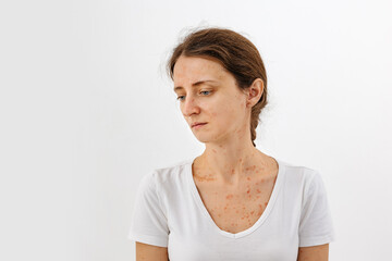 Portrait of a girl with skin diseases that worsen the quality of human life. Dermatitis, allergy,...