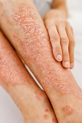 A human legs, which are in the phase of exacerbation of a skin disease. Dermatitis, allergy, eczema, psoriasis concept.