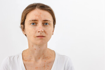 Portrait of a girl with skin diseases that worsen the quality of human life. Dermatitis, allergy, eczema, psoriasis concept. White background, banner, copy space.