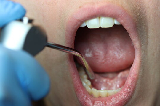 Close up of a dentist using suction device to clean the month