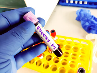 Biological specimen (blood) in vacuum tube for pathological analysis. Medical laboratory various...
