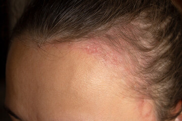 Inflammation of the scalp in a young woman. Problems with dandruff, seborrhea, itching, redness, dryness, lichen, fungal infection. Skin disease, dermatitis. Red round spots on the head and forehead