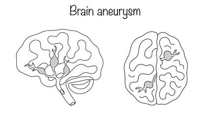 Brain aneurysms