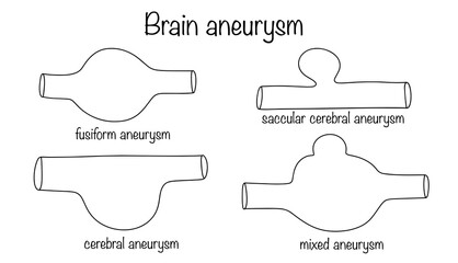 Brain aneurysm
