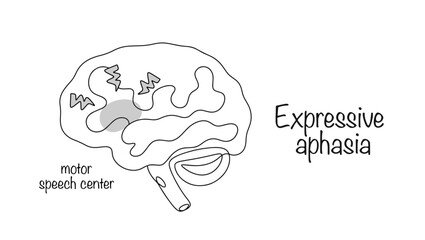 Expressive aphasia