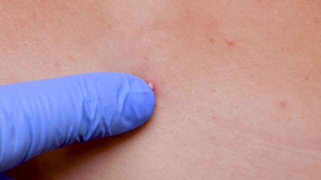 Young girl shows pimples on her skin on her back and shoulders. Beautician removes pimples on her skin