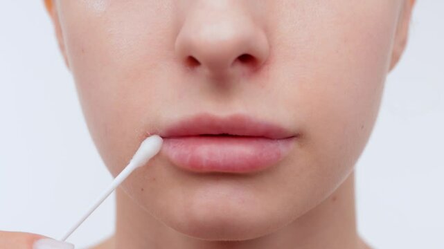 Woman showing herpes disease on her lips. Treatment of viral infections.