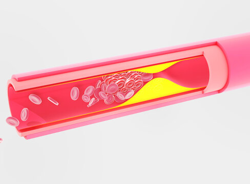 Anatomical 3D illustration of the interior of an artery obstructed by fat (cholesterol) that has been accumulating. Red blood cells in an interrupted blood circulation. Capillary. White background.