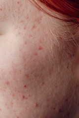 Fototapeta premium Pimple or acne. Skin treatment. Medicine and cosmetology concept. Natural skin. Skin acne background. Closeup acne pimple. Treatment for acne. Problem skincare. Pimples, pores, scars. Natural skin.