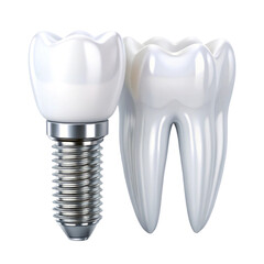 Isolated set of white teeth and dental implant on transparent background