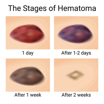 Healing Stages of Bruises and Hematomas