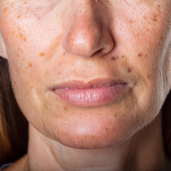 Fototapeta premium Woman Suffering From Actinic Keratosis