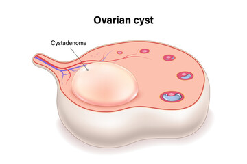 Cystadenoma cyst cross section vector. Ovarian cysts. Female ovarian disease.